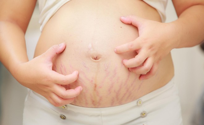 5 cách giúp mẹ bầu cải thiện các vết sạm da sử dụng nguyên liệu hoàn toàn tự nhiên - Ảnh 1.