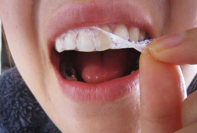 Sử dụng miếng dán làm trắng răng có thật sự tốt - Những điều chị em không thể không biết - Ảnh 2.