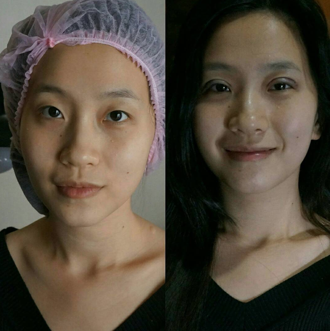 Bác sĩ thẩm mỹ nói về vụ cắt mí gây bão: có thể sưng và đỏ sau thủ thuật, nhưng về mỹ quan thì hỏng - Ảnh 4. Bác sĩ thẩm mỹ nói về vụ cắt mí gây bão: có thể sưng và đỏ sau thủ thuật, nhưng về mỹ quan thì hỏng - Ảnh 4.