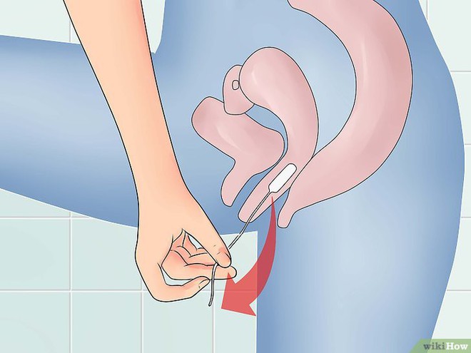 Để quên tampon trong âm đạo và đây là những hệ lụy bạn nhất định phải biết để tránh - Ảnh 3.
