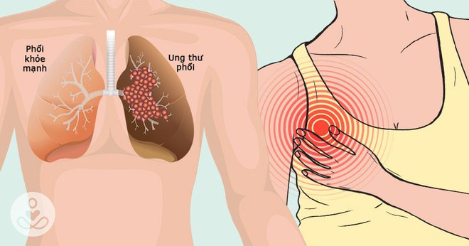 Không chỉ có ho, đây còn là 5 dấu hiệu lén lút của bệnh ung thư phổi nhiều người chưa biết - Ảnh 2.