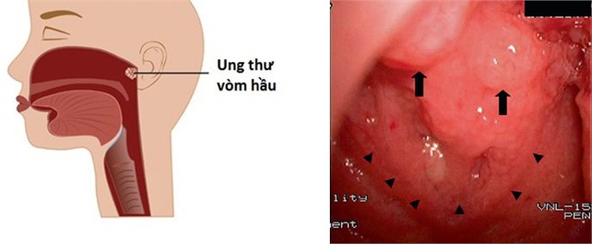 3 yếu tố làm tăng nguy cơ bị ung thư vòm họng mà rất nhiều người bỏ qua - Ảnh 1.