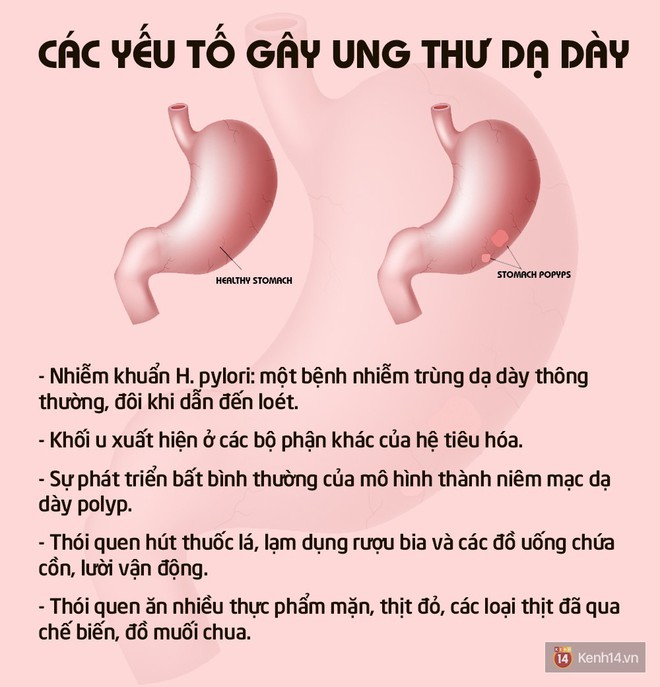 Những điều ai cũng cần biết về ung thư dạ dày để ngăn ngừa và nhận biết sớm nhất - Ảnh 2.