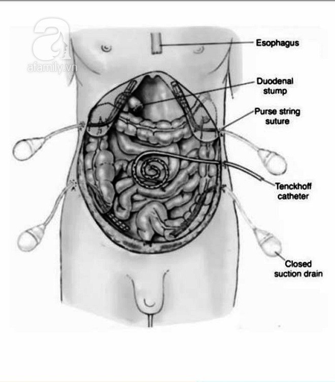 Thấy máu trong phân, coi chừng đã mắc ung thư đại trực tràng - Ảnh 1.