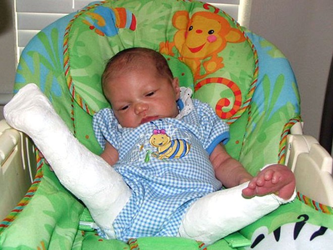 Sinh ra với đôi chân bị bẻ quặt ra phía trước, 8 năm sau, cô bé trở lại bệnh viện và khiến cho các bác sĩ tròn mắt kinh ngạc - Ảnh 2.
