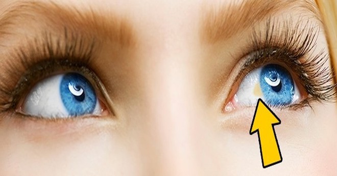 Đừng chủ quan bỏ qua nếu thấy mắt xuất hiện các triệu chứng bất thường sau - Ảnh 4.