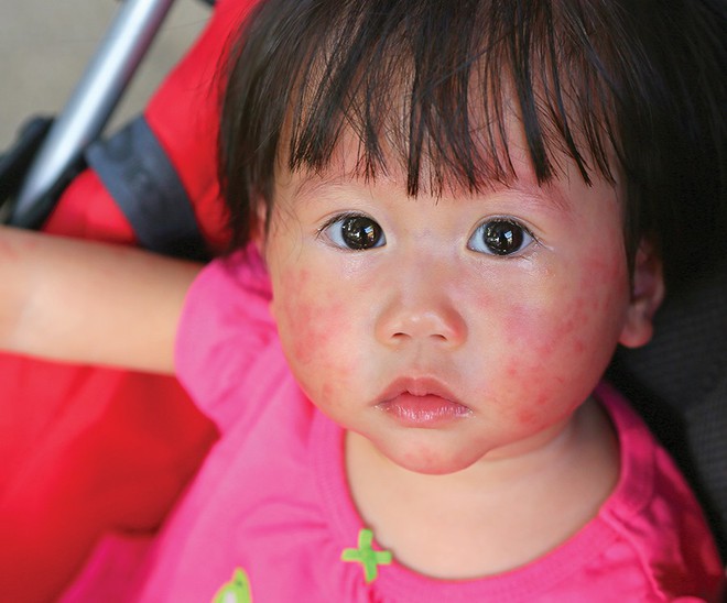 Bệnh phát ban đỏ nhiễm khuẩn cấp dễ gây nhầm lẫn ở trẻ nhỏ vào mùa đông - Ảnh 1.