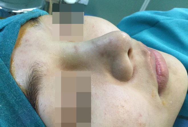 Cô gái 21 tuổi bị biến dạng mặt vì đi nâng mũi bằng chỉ - Ảnh 1.