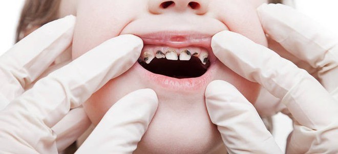 Nếu vẫn tự tin con đánh răng đủ 3 lần mỗi ngày sẽ không bị sâu răng thì cha mẹ hãy xem lại - Ảnh 1.