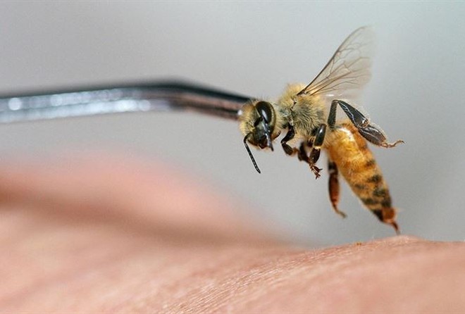 Tử vong do chữa bệnh bằng cách cho ong đốt - Lời cảnh tỉnh cho người muốn chữa bệnh bằng nọc ong - Ảnh 3.