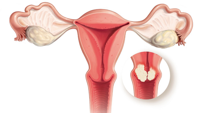 Tiêm phòng ngừa ung thư cổ tử cung: những thông tin nhất định con gái phải biết - Ảnh 1.