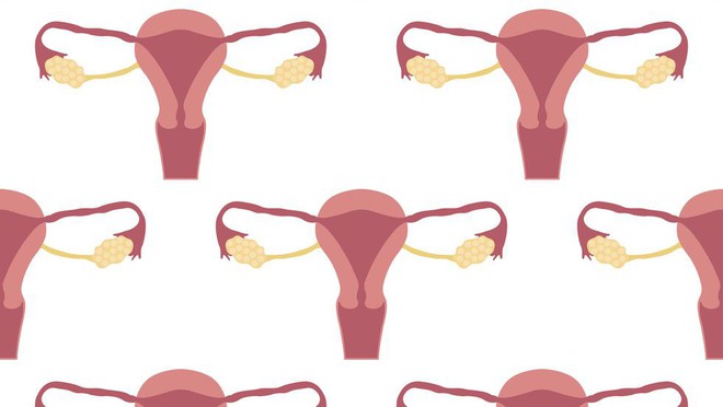 6 triệu chứng của u xơ tử cung - căn bệnh phụ khoa rất nhiều chị em gặp phải - Ảnh 1.