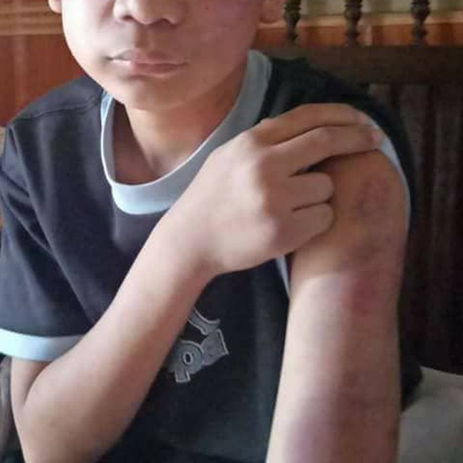 Hà Nội: Thêm một bé trai 14 tuổi nghi bị cha đẻ và mẹ kế giam giữ dùng gậy gỗ đánh tím mắt - Ảnh 1.
