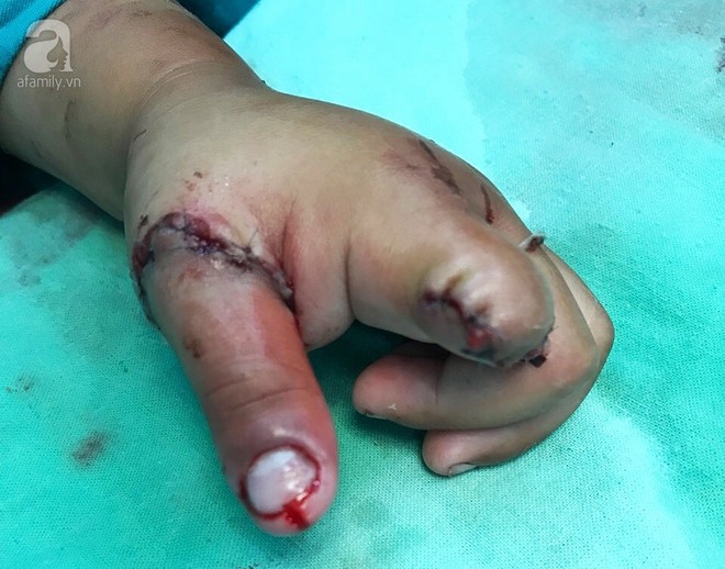 Long An: Bé trai 3 tuổi bị dây sên xe máy cuốn đứt lìa hai ngón tay - Ảnh 1.