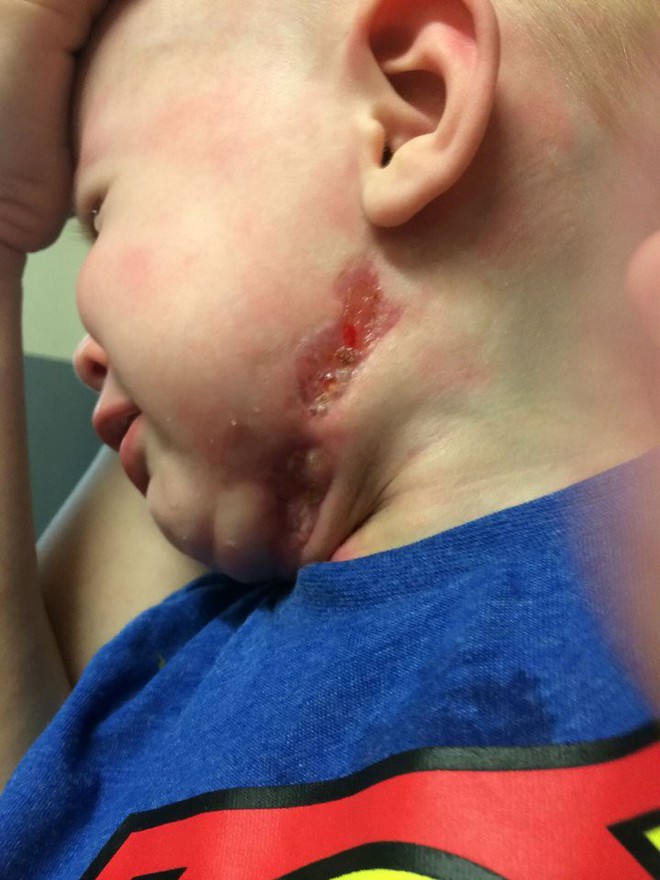 Nhiễm vi khuẩn ăn thịt người do biến chứng từ căn bệnh phổ biến, bé trai 13 tháng tuổi tính mạng nguy kịch - Ảnh 4.