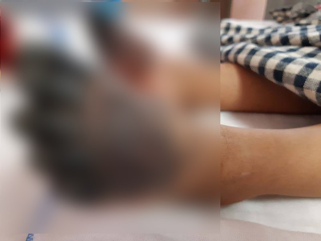 Bé gái 3 tuổi bị hoại tử tứ chi chỉ sau cơn sốt, nguy cơ phải tháo khớp trong vài ngày nữa - Ảnh 2. Bé gái 3 tuổi bị hoại tử tứ chi chỉ sau cơn sốt, nguy cơ phải tháo khớp trong vài ngày nữa - Ảnh 2.