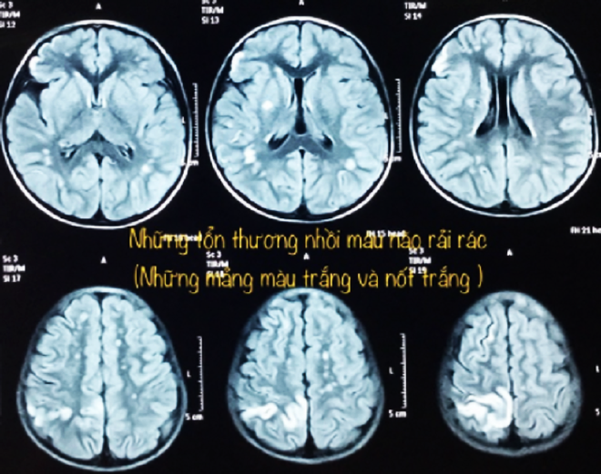 TP.HCM: Nhiều trẻ yếu nửa người vì bệnh Moyamoya - Ảnh 2. TP.HCM: Nhiều trẻ yếu nửa người vì bệnh Moyamoya - Ảnh 2.