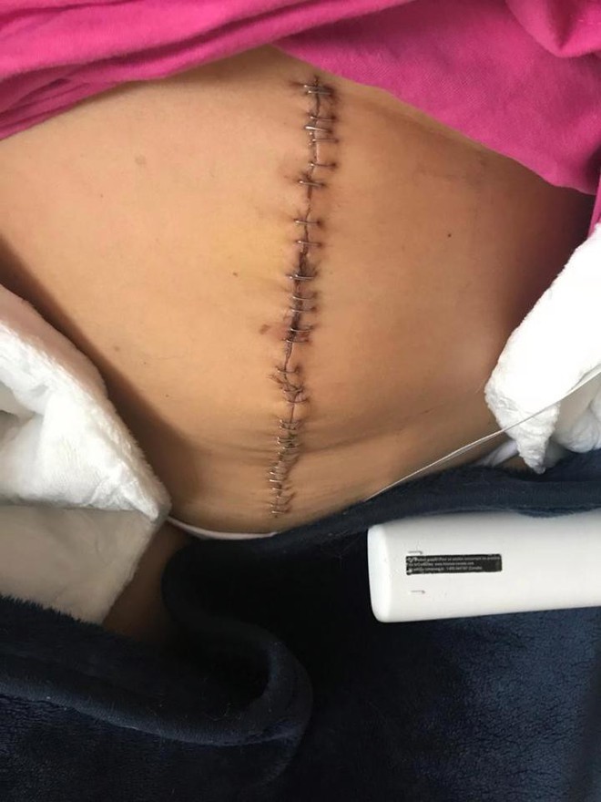 Cô giáo bị sốc khi phát hiện ra vết thâm tím bình thường trên bụng lại là dấu hiệu của ung thư buồng trứng - Ảnh 3.