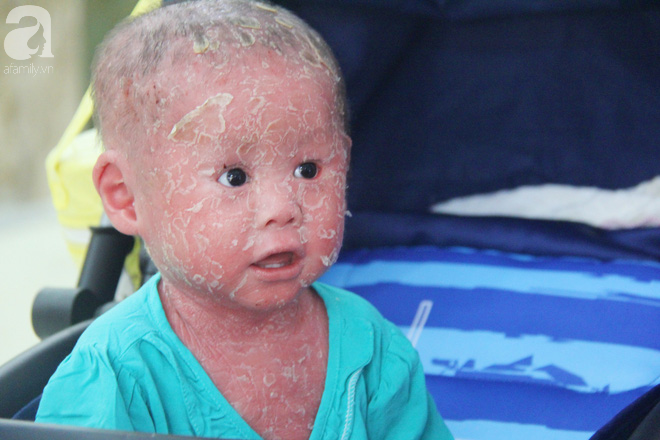 Bé Bích 14 tháng tuổi bị bố mẹ bỏ rơi, người đầy vẩy ngứa như da trăn đã nhập viện Da Liễu TP.HCM để điều trị - Ảnh 2.