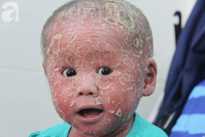 Bé Bích 14 tháng tuổi bị bố mẹ bỏ rơi, người đầy vẩy ngứa như da trăn đã nhập viện Da Liễu TP.HCM để điều trị - Ảnh 12.
