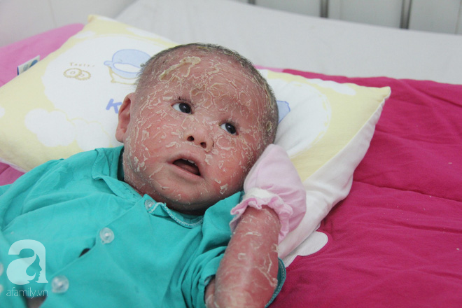 Bé Bích 14 tháng tuổi bị bố mẹ bỏ rơi, người đầy vẩy ngứa như da trăn đã nhập viện Da Liễu TP.HCM để điều trị - Ảnh 13.