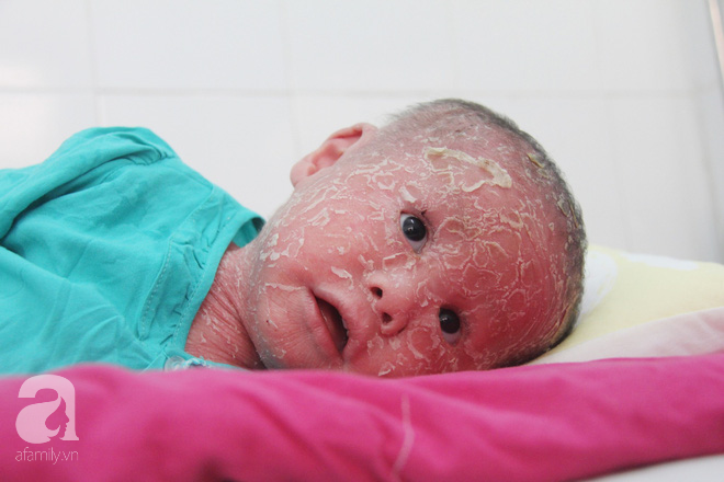 Bé Bích 14 tháng tuổi bị bố mẹ bỏ rơi, người đầy vẩy ngứa như da trăn đã nhập viện Da Liễu TP.HCM để điều trị - Ảnh 8.