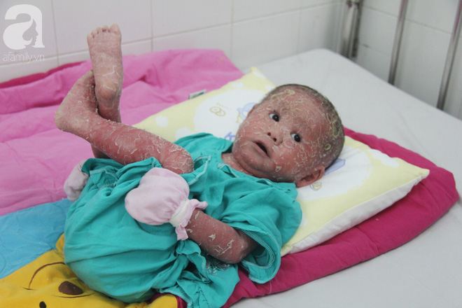 Bé Bích 14 tháng tuổi bị bố mẹ bỏ rơi, người đầy vẩy ngứa như da trăn đã nhập viện Da Liễu TP.HCM để điều trị - Ảnh 9.