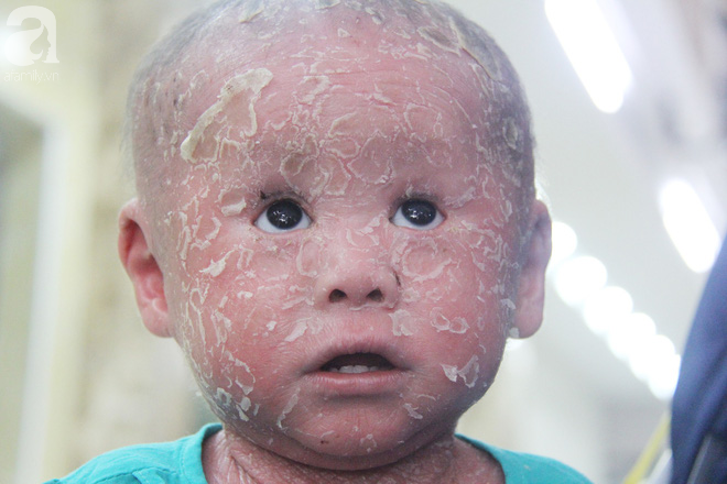 Bé Bích 14 tháng tuổi bị bố mẹ bỏ rơi, người đầy vẩy ngứa như da trăn đã nhập viện Da Liễu TP.HCM để điều trị - Ảnh 6.