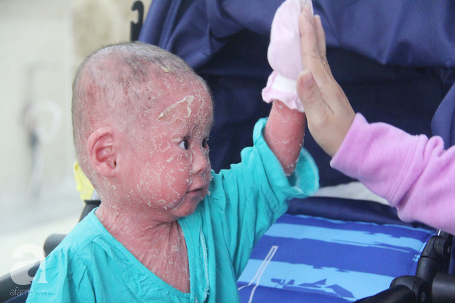 Bé Bích 14 tháng tuổi bị bố mẹ bỏ rơi, người đầy vẩy ngứa như da trăn đã nhập viện Da Liễu TP.HCM để điều trị - Ảnh 7.