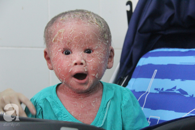 Bé Bích 14 tháng tuổi bị bố mẹ bỏ rơi, người đầy vẩy ngứa như da trăn đã nhập viện Da Liễu TP.HCM để điều trị - Ảnh 5.