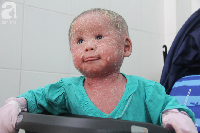 Bé Bích 14 tháng tuổi bị bố mẹ bỏ rơi, người đầy vẩy ngứa như da trăn đã nhập viện Da Liễu TP.HCM để điều trị - Ảnh 3.
