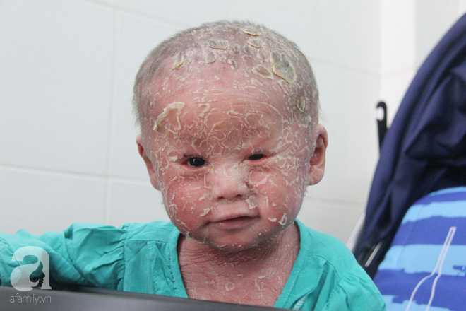 Bé Bích 14 tháng tuổi bị bố mẹ bỏ rơi, người đầy vẩy ngứa như da trăn đã nhập viện Da Liễu TP.HCM để điều trị - Ảnh 16.