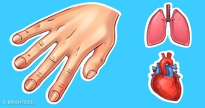 Hãy xòe đôi bàn tay ra trước mặt: Bạn có thể đoán bệnh qua 7 dấu hiệu này trên tay - Ảnh 7.
