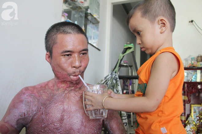 Bố bị điện giật cháy cả người không có tiền chữa, bé trai 4 tuổi sợ hãi nép vào lòng mẹ vì không nhận ra - Ảnh 3. Bố bị điện giật cháy cả người không có tiền chữa, bé trai 4 tuổi sợ hãi nép vào lòng mẹ vì không nhận ra - Ảnh 3.