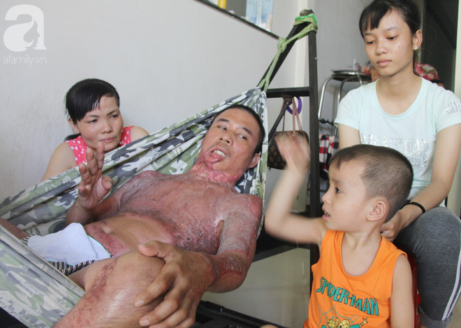 Bố bị điện giật cháy cả người không có tiền chữa, bé trai 4 tuổi sợ hãi nép vào lòng mẹ vì không nhận ra - Ảnh 14. Bố bị điện giật cháy cả người không có tiền chữa, bé trai 4 tuổi sợ hãi nép vào lòng mẹ vì không nhận ra - Ảnh 14.