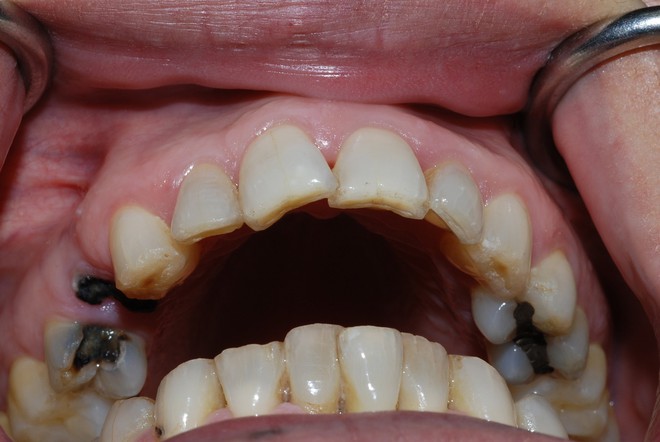 Chủ quan với chiếc răng sâu, chàng trai 26 tuổi đã ra đi mãi mãi - Ảnh 3. Chủ quan với chiếc răng sâu, chàng trai 26 tuổi đã ra đi mãi mãi - Ảnh 3.