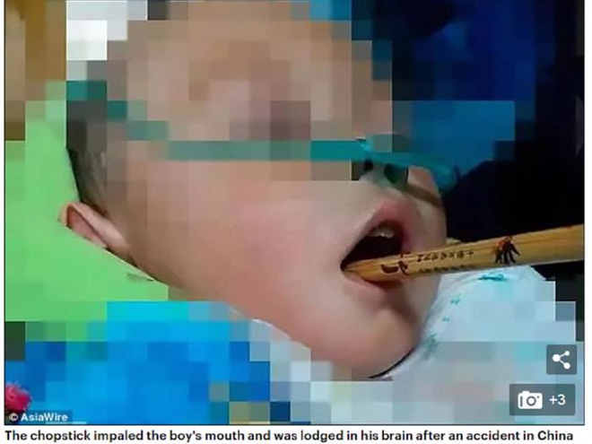 Cầm bút bi chạy chơi, bé gái 4 tuổi bị bút đâm xuyên thấu ngực - Ảnh 5.