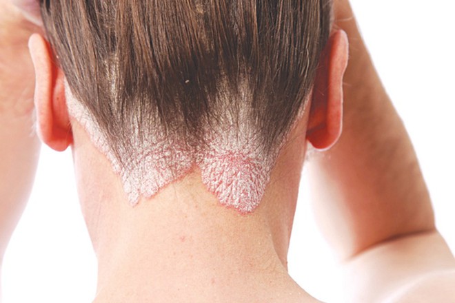Muốn nhận biết bệnh eczema nhanh chóng và chính xác nhất định phải nắm rõ những dấu hiệu sau - Ảnh 2.