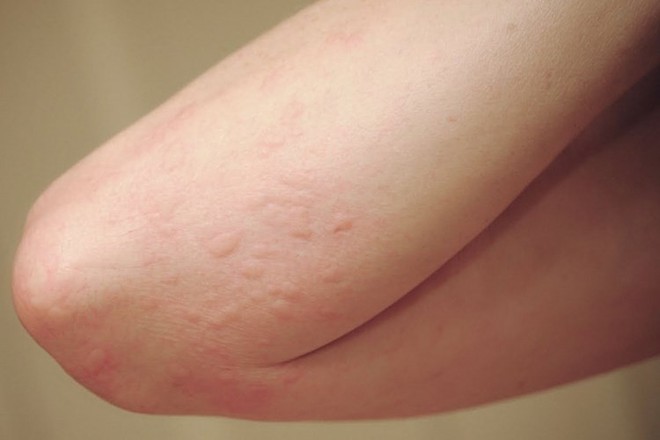 Muốn nhận biết bệnh eczema nhanh chóng và chính xác nhất định phải nắm rõ những dấu hiệu sau - Ảnh 3.