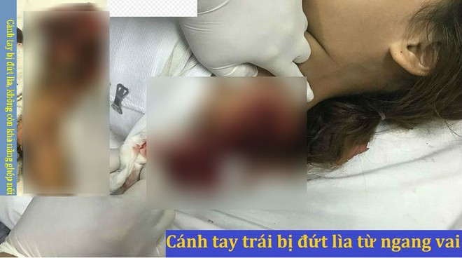 Chơi trốn tìm cùng bạn, bé gái bị máy cưa cắt đứt lìa cánh tay trái vĩnh viễn - Ảnh 1.