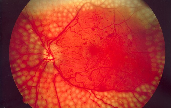 4 căn bệnh ở mắt nếu không chữa trị sớm có thể dẫn tới nguy cơ mù lòa - Ảnh 3.