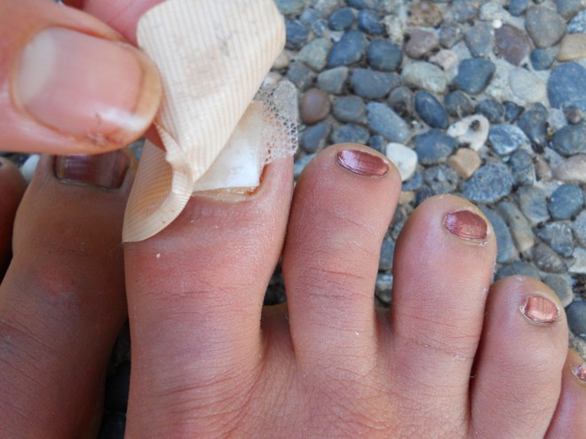 Những lỗi đi giày trong mùa hè ai cũng từng mắc phải gây hại nghiêm trọng đến sức khỏe - Ảnh 3.