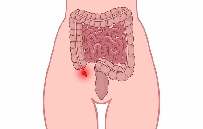 Mọi người cần đến bác sĩ càng sớm càng tốt khi nhận thấy những triệu chứng này của bệnh viêm ruột thừa - Ảnh 1.