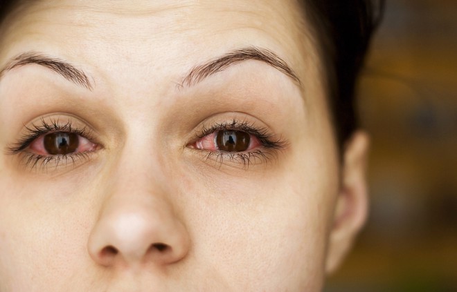 Vệt đỏ trong mắt có thể ngầm báo hiệu một số vấn đề sức khỏe nghiêm trọng - Ảnh 3.