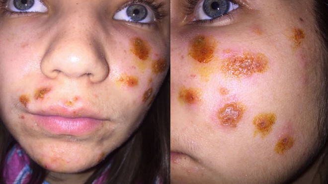 Lột da bằng hóa chất, người phụ nữ đau đớn mang về một gương mặt đầy vết bỏng rộp và nhiễm trùng đáng sợ - Ảnh 2.