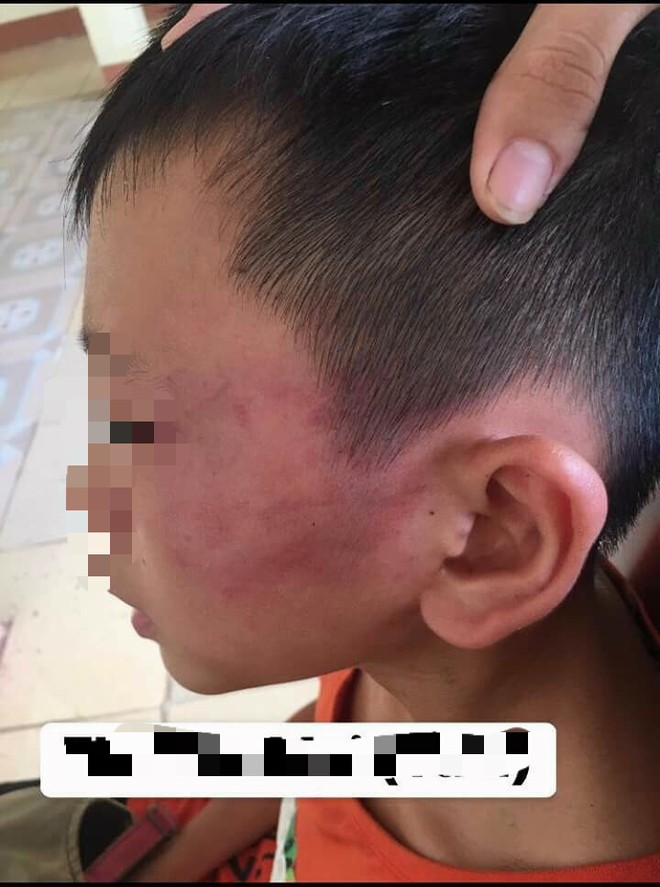 Bé trai 12 tuổi nghi bị mẹ kế bạo hành ở Nghệ An vẫn chưa hết sợ hãi khi nhắc tới chuyện về nhà - Ảnh 1.