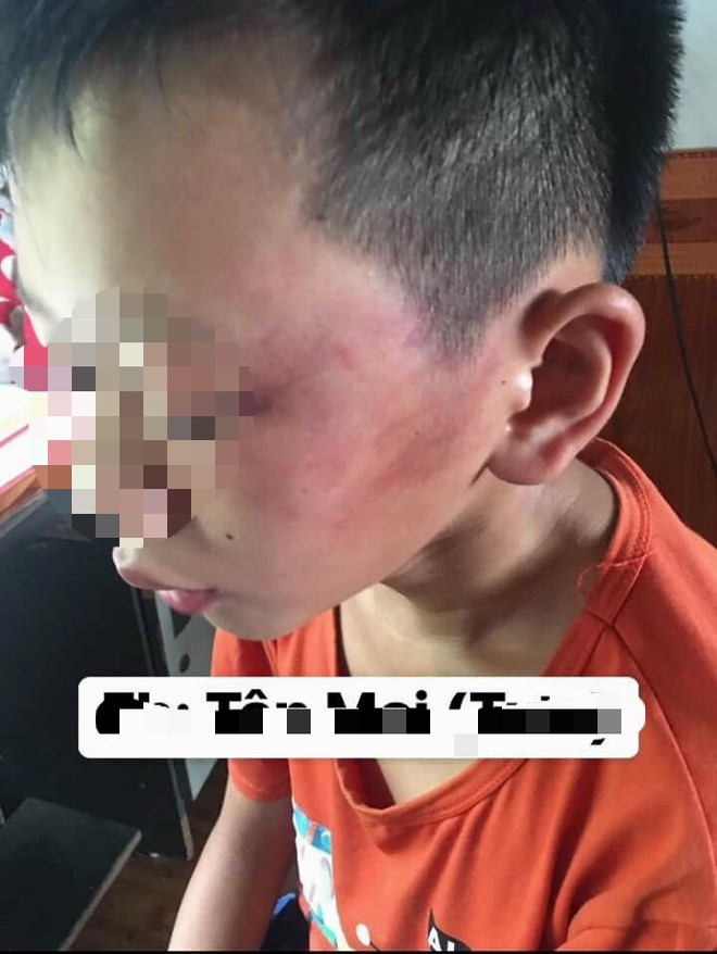 Nghệ An: Nghi án bé trai 12 tuổi bị mẹ kế đánh thương tích đầy mình phải nhập viện - Ảnh 2.