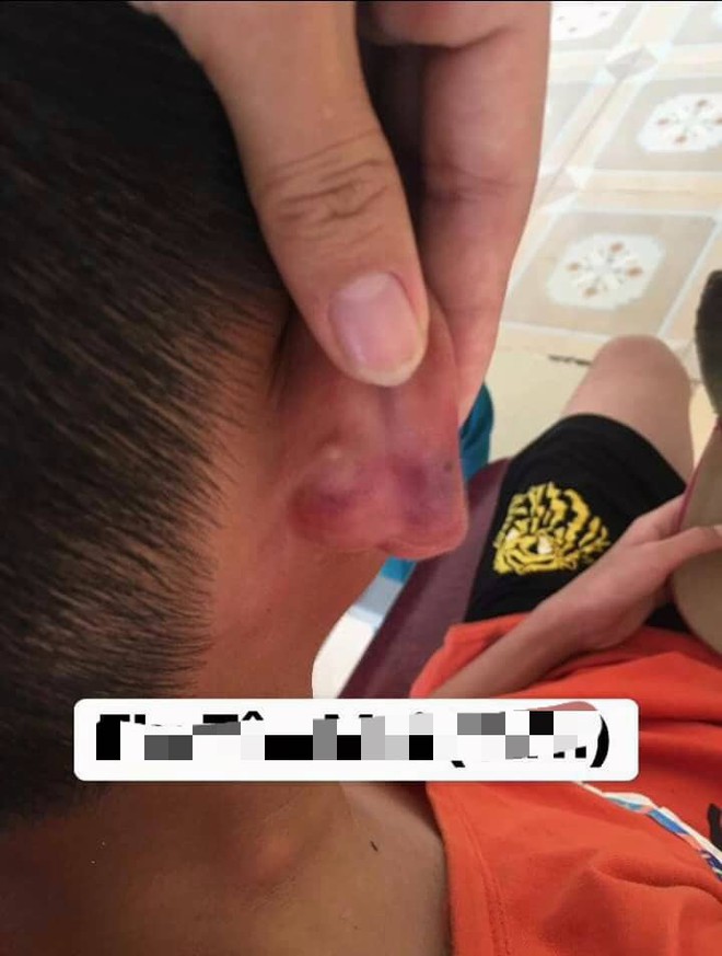 Nghệ An: Nghi án bé trai 12 tuổi bị mẹ kế đánh thương tích đầy mình phải nhập viện - Ảnh 3.