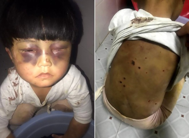 TQ: Bé gái 4 tuổi bị bố đánh bầm tím mắt, lưng bị dí tàn thuốc lá, xích trong nhà vệ sinh - Ảnh 1.