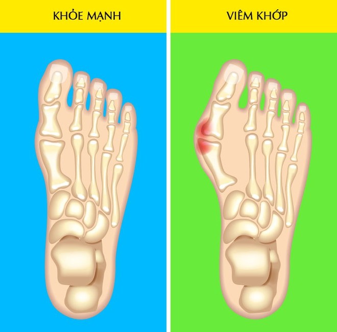 Hãy nhìn xuống đôi chân mình và xem nó đang cảnh báo bạn những vấn đề gì về sức khỏe - Ảnh 7.